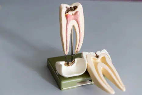 Wurzelbehandlung auch Wurzelkanalbehandlung - Fair Doctors Zahnarzt