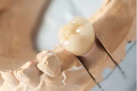 Vollkeramikkrone - Kosten & Ablauf - Zahnkrone & Zahnersatz beim Zahnarzt