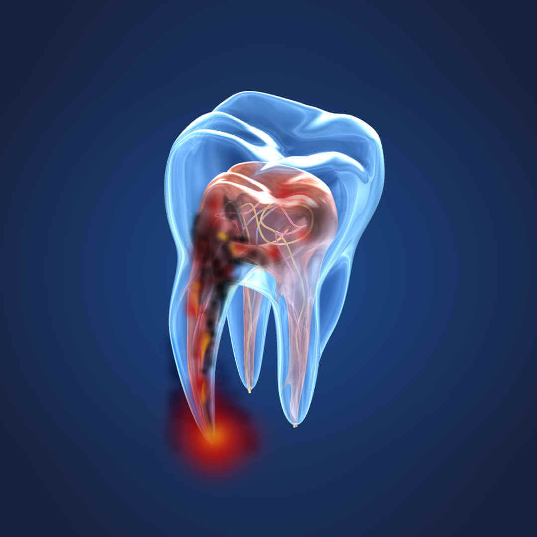 Wurzelspitzenresektion: Schwellung, Erfolgsquote, Dauer und Ablauf beim Zahnarzt