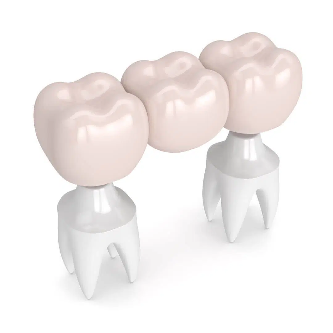 Ist Ihre Zahnbrücke locker, gebrochen, rausgefallen, möchten Sie erneuern oder entfernen? Ihr Fair Doctors Zahnarzt