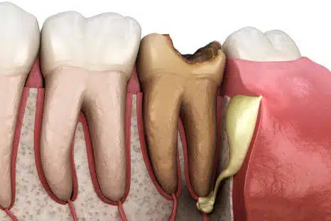 Zahnabszess behandeln - Wurzelbehandlung oder Wurzelspitzenresektion beim Fair Doctors Zahnarzt
