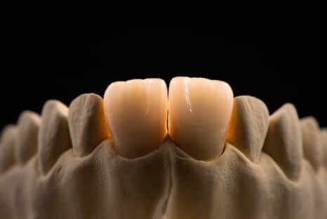 Zahnaufbau bei abgebrochenen Zahn - Schneidezahn - Fair Doctors Zahnarzt