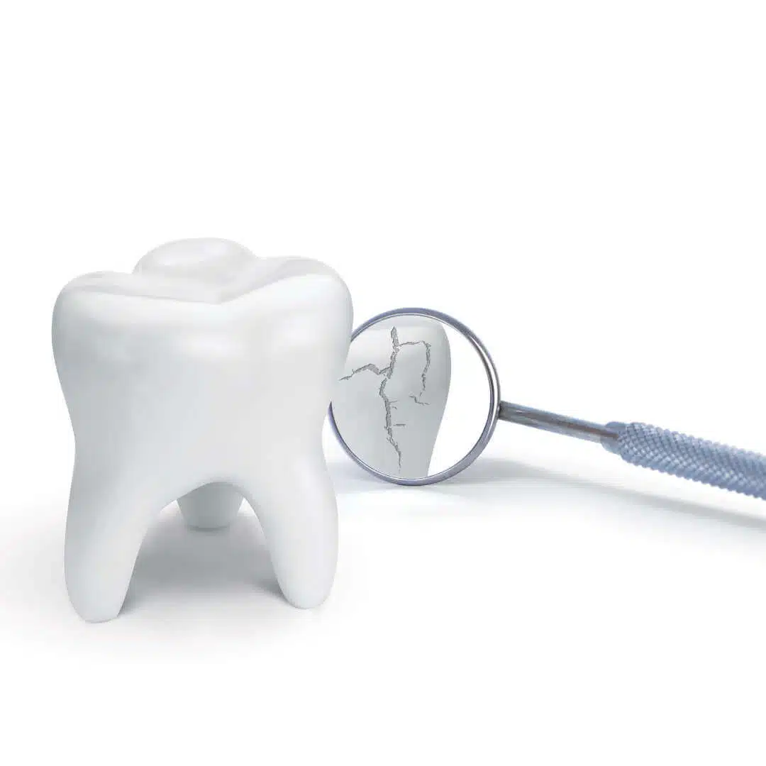 Zahnaufbau bei abgebrochenen Zahn, Schneidezahn - Ihr Fair Doctors Zahnarzt
