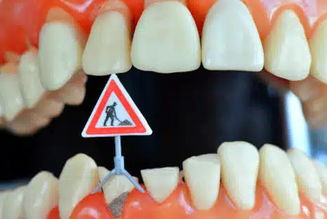 Zahnaufbau bei abgebrochenen Zahn & Schneidezahn - Ihr Zahnarzt hilft