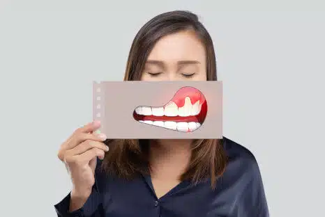 Zahnfleischwucherung, Ursachen & was hilft - Zahnarzt NRW