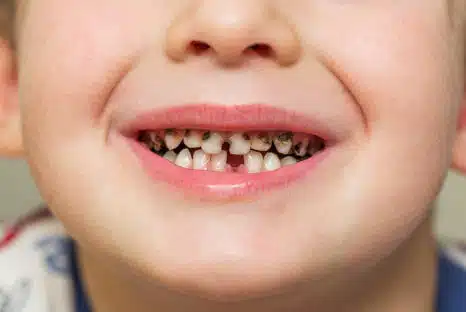 Zahnhalskaries, Behandlung - Ihr Fair Doctors Zahnarzt in NRW
