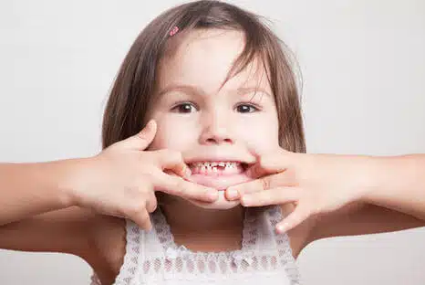Kreidezähne, Ursache und Behandeln beim Fair Doctors Zahnarzt NRW