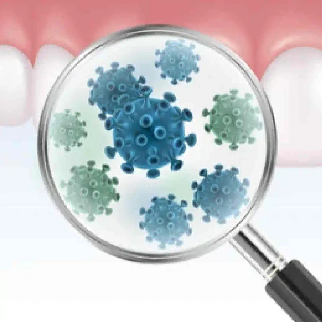Parodontose Bakterien, Zahnbakterien entfernen beim Fair Doctors Zahnarzt in NRW