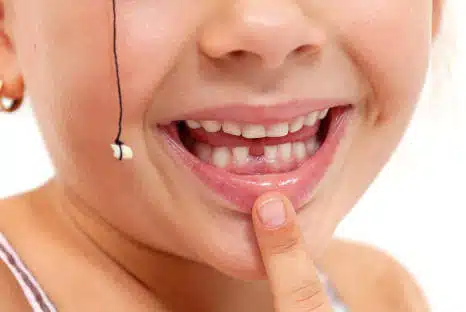 Zahnentfernung, Zahn ziehen, Ihr Fair Doctors Zahnarzt