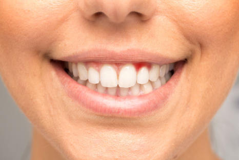 Zahnfleischerkrankung, Wildes und krankes Zahnfleisch