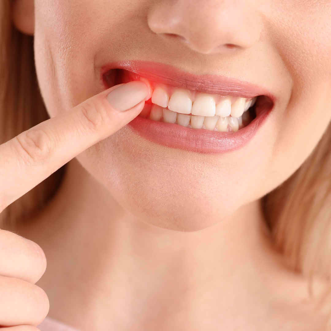 Zahnfleischerkrankung, Wildes und krankes Zahnfleisch behandeln