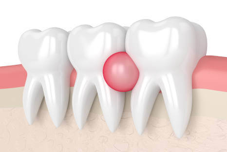 Kieferzyste, Zyste im Zahnfleisch oder Zahnzyste entfernen beim Zahnarzt in NRW