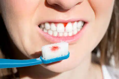 Zahnfleischbluten stoppen, Ursachen, was tun
