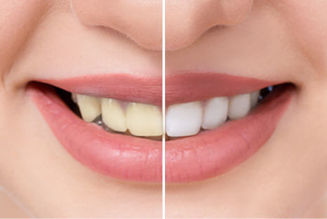 Professionelles Zahnbleaching, Wie lange hält Bleaching, Fair Doctors Zahnarzt