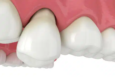 Freiliegender Zahnhals, Schmerzen, freiliegende Zahnhälse versiegeln, Fair Doctors, Zahnarzt in ganz NRW