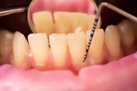 Zahnfleischtaschen, reinigen, behandeln, behandeln, Fair Doctors Zahnarzt NRW