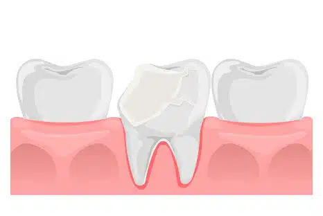 Abgebrochener Zahn, Ursachen, Zahnarztpraxis NRW, Fair Doctors Zahnarzt