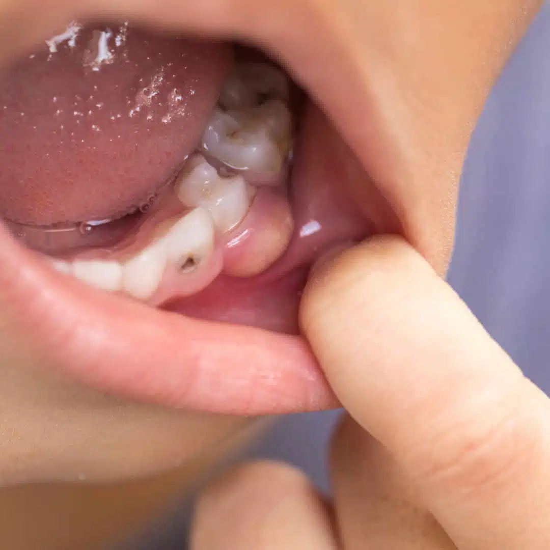 Eiterblase am Zahnfleisch, Eiter Zahnfleisch aufstechen, Fair Doctors