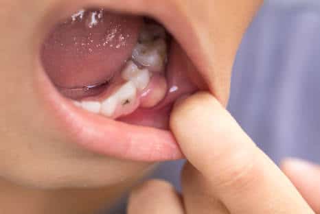 Eiterblase am Zahnfleisch, Eiter Zahnfleisch aufstechen, Fair Doctors Zahnarzt