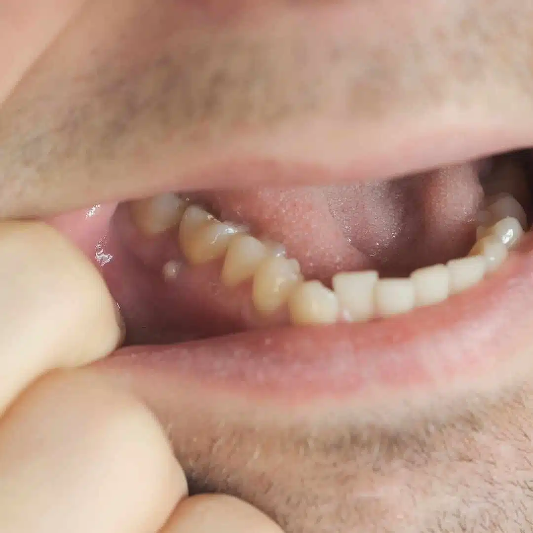 Zahnfistel, Symptome, Behandlung, Fistel am Zahn, Zahnarzt NRW