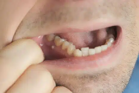 Zahnfistel, Symptome, Behandlung, Fistel am Zahn, Zahnarzt NRW