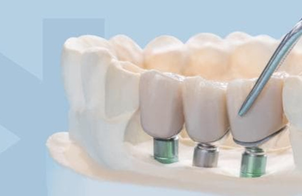 zahnarzt-neue-zähne-zahnersatz