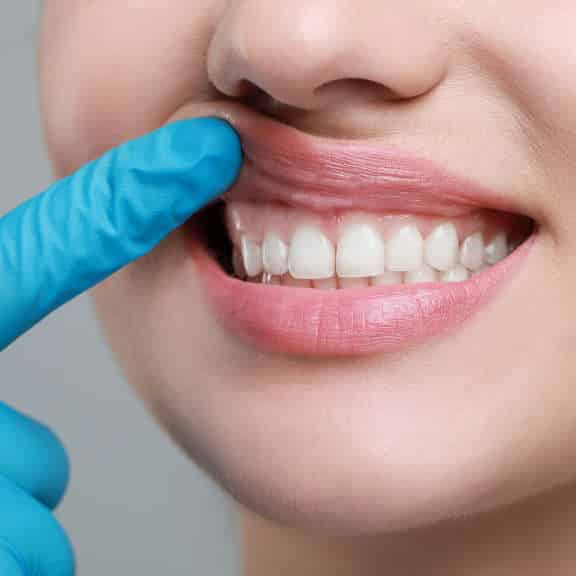 Zahnschmelzabbau stoppen, Ursachen, Behandlung, Fair Doctors Zahnarzt