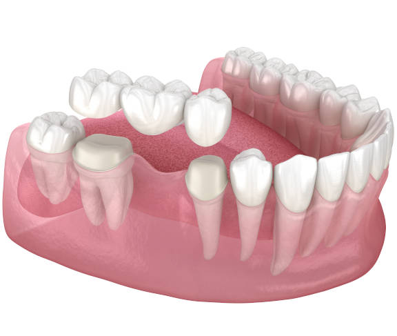 Zahnersatz ohne Zuzahlung, Neue Zähne