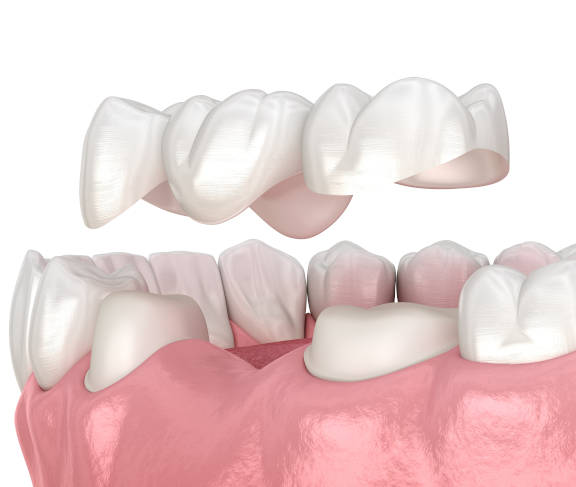 Zahnersatz ohne Zuzahlung, Zahnarzt NRW